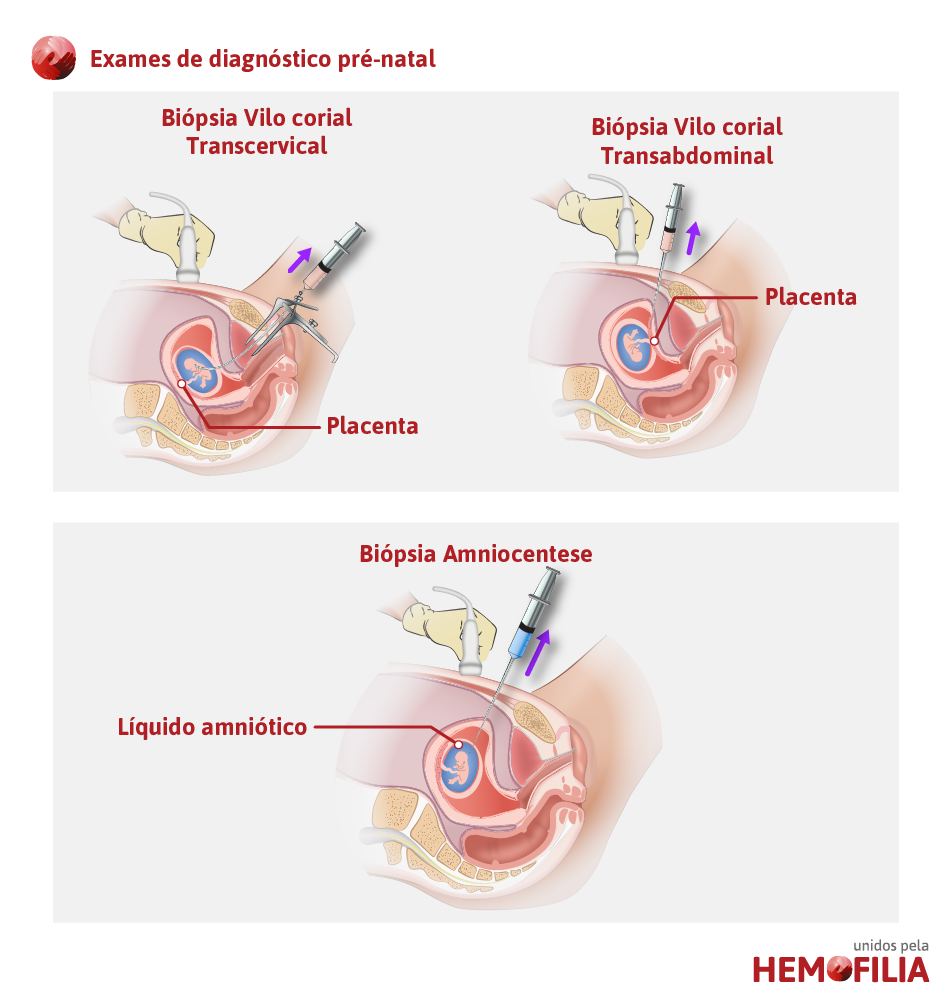 Diagnóstico pré-natal | Unidos pela Hemofilia
